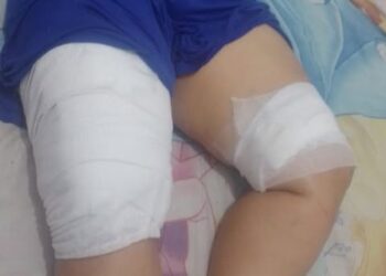 La mujer tiene el 18% de quemaduras en las piernas luego de ser atacada por su expareja con agua caliente.