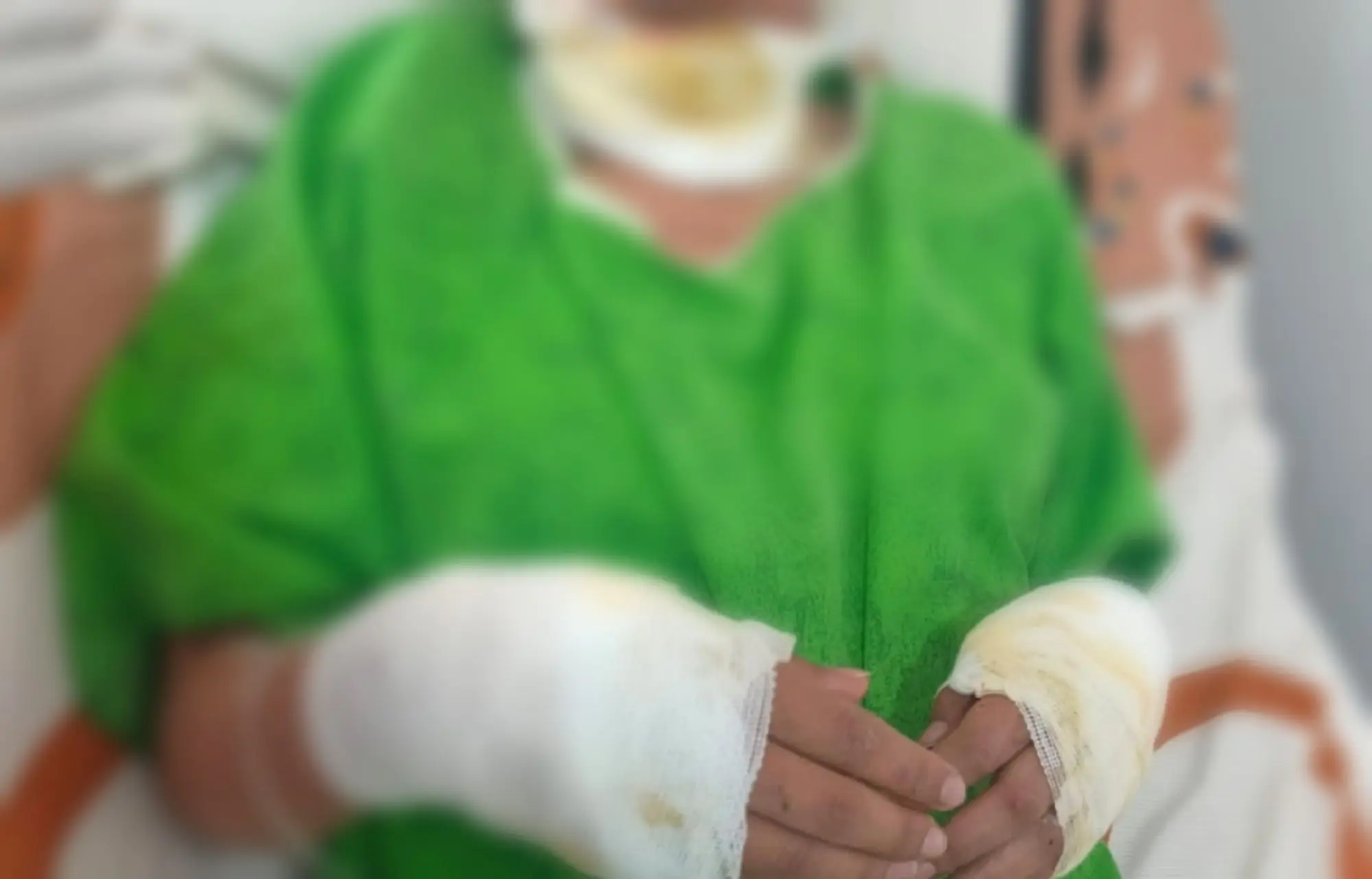 La adolescente atacada por sus padres tiene quemaduras de primer y segundo grado. FOTO: Fiscalía de Oruro